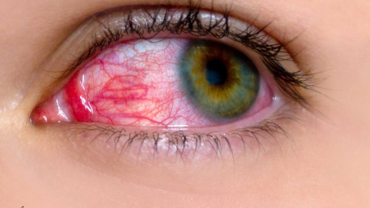 علت قرمزی چشم چیست ؟ روش های درمان قرمزی چشم