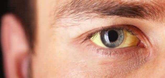 لکه‌های زرد چشم نشانه اولیه کدام بیماری است؟