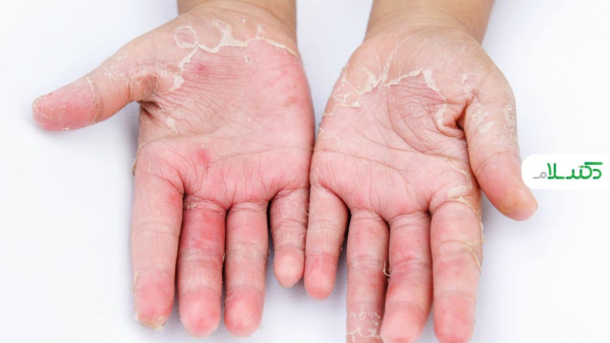 چه عواملی باعث پوست پوست شدن دست ها می شوند؟