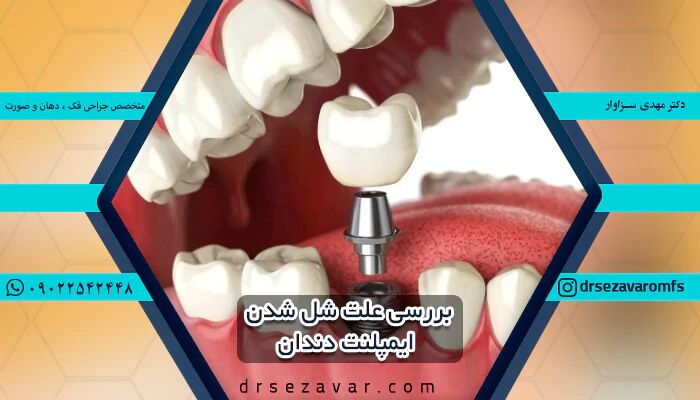 دلایل آسیب دیدن ایمپلنت دندان و درمان آن