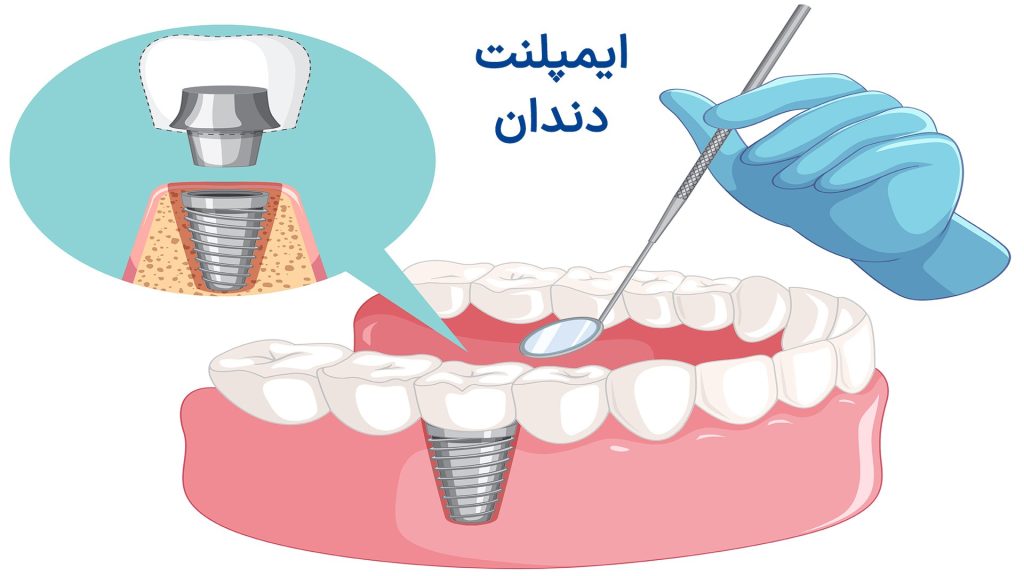 روش کاشت ایمپلنت دندانی