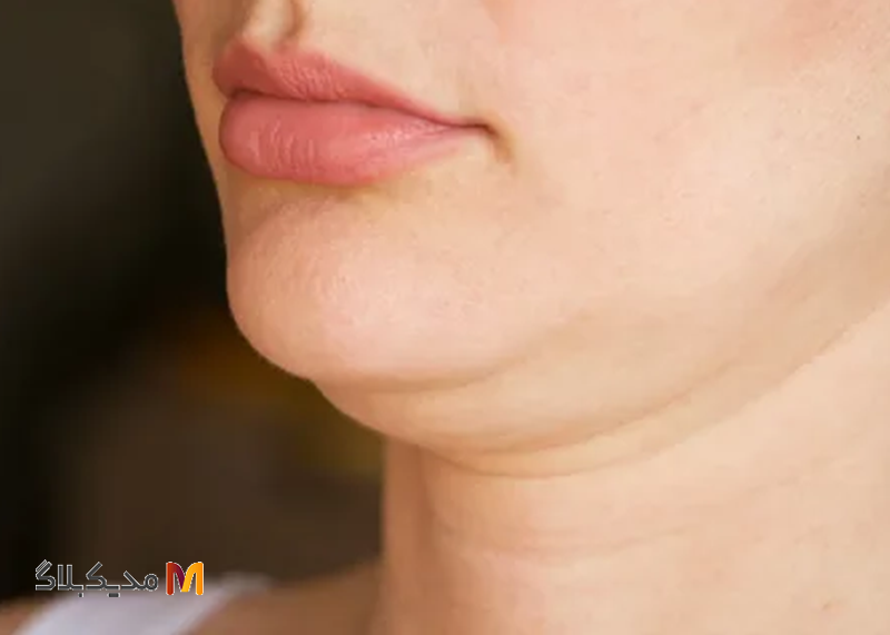 غبغب چیست؟ 10 درمان موثر برای رفع غبغب